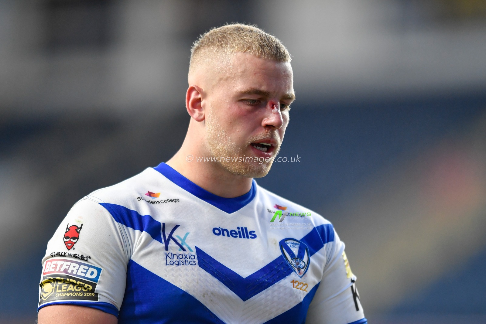 Jack Ashworth (17) of St Helens with a cut on his nose